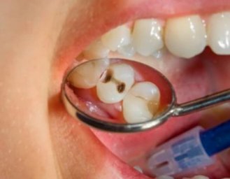Профилактика кариеса: советы стоматологов