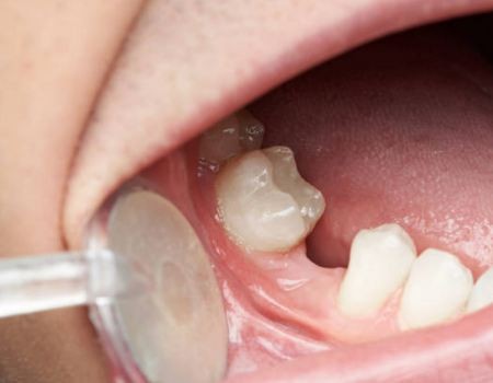 Почему нужно протезировать зубы