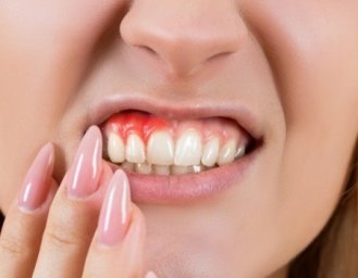 Флюс или абсцесс? Как распознать опасность и спасти зубы