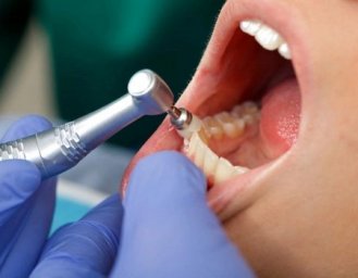 Профессиональное лечения зубного налета