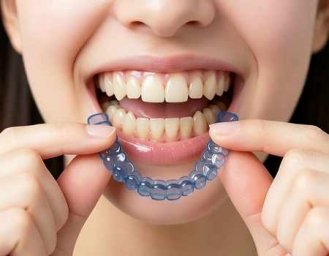 Элайнеры для исправления прикуса