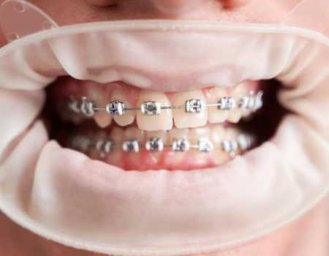 Виды брекетов: металлические, керамические, сапфировые