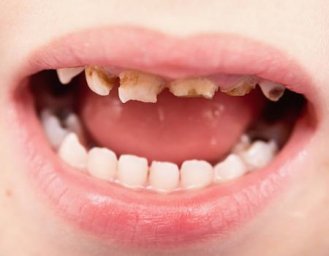 Какие болезни зубов могут быть у детей?